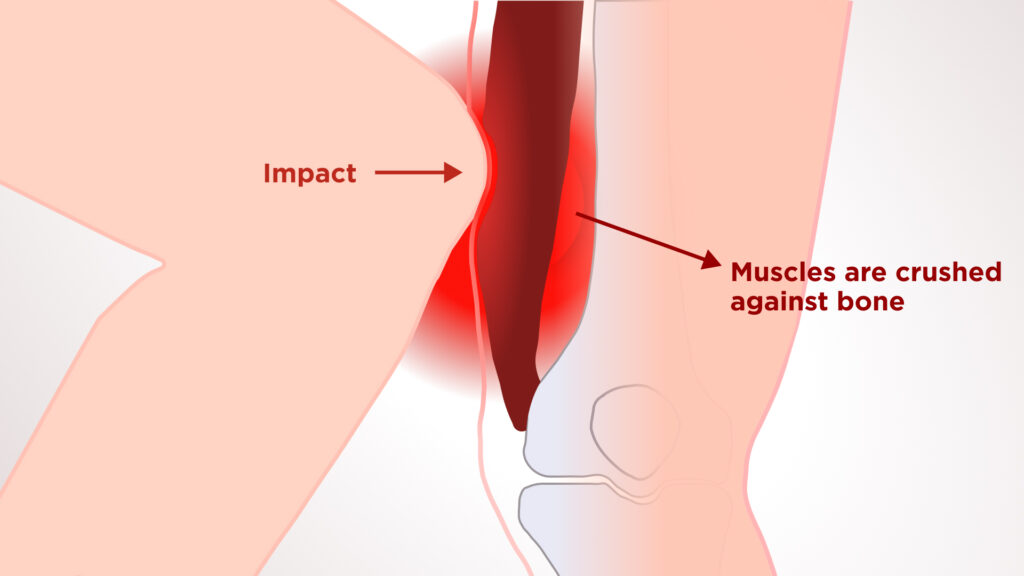 Muscle Contusions Blog Thumbnail