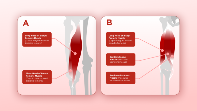 Hamstring injuries anatomy